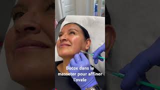 Injection de botox dans le masséter pour affiner l’ovale du visage DrHerveRaspaldo [upl. by Ralyt973]