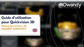 Waxup in QuickVision 3D OWANDY RADIOLOGY [upl. by Irrehs]