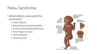 HSC 425  Down Patau Edwards Syndrome [upl. by Ahsikym]