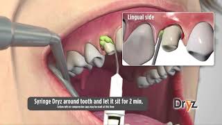 Dryz® Hemostatic Retraction Paste by Parkell Inc [upl. by Enneibaf]