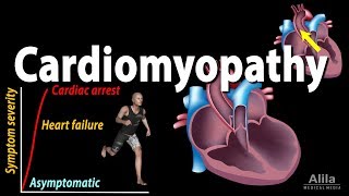 Cardiomyopathy animation [upl. by Ricketts136]