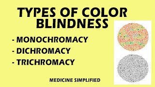 Color Blindness  Types of color blindness  Monochromacy  Dichromacy  trichromacy medicine [upl. by Atcele286]