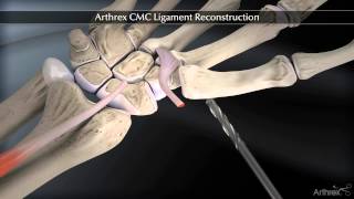 Arthrex CMC Ligament Reconstruction [upl. by Rubie992]