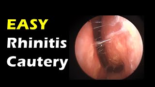 Very Easy Rhinitis treatment simple cautery [upl. by Otes]