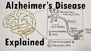 Alzheimers disease and amyloid beta  Immune system and amyloid beta [upl. by Zak]