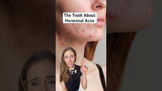 Hormonal Acne Is A Mixed Bag  Heres What You Need To Know dermatologist [upl. by Adyol307]