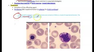 Sideroblastic AnemiaMicrocytic Anemia [upl. by Mauchi134]