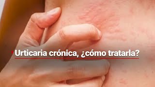 COMEZÓN POR TODAS PARTES  ¿Qué puede provocar la urticaria crónica y cómo tratarla [upl. by Abra]