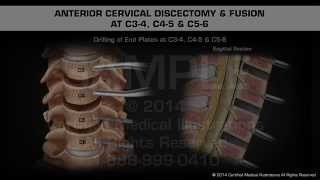 Anterior Cervical Discectomy amp Fusion at C34 C45 amp C56 [upl. by Ellimac414]