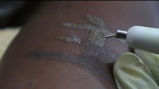 Plasma fibroblast tattoo removaltattooremoval [upl. by Suvart397]