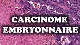 LE CARCINOME EMBRYONNAIRE – PATHOLOGIE [upl. by Alam]