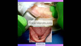 Mandibular Torus Reduction Video [upl. by Alleyne]