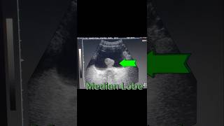 Prostatomegaly  Enlarged Prostate  Median Lobe  Urine Retention on Ultrasound [upl. by Muriel516]