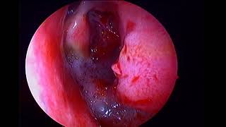 Left inverted papilloma with sinonasal polyposis [upl. by Lockhart216]