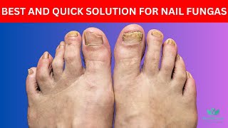 You Need Only 1 Ingredient To Get Rid of Nail Fungus Completely [upl. by Enert]