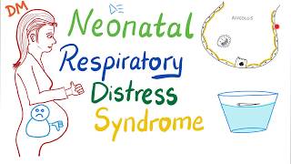 Neonatal Respiratory Distress Syndrome NRDS  Pediatrics  Pulmonology [upl. by Dinerman]