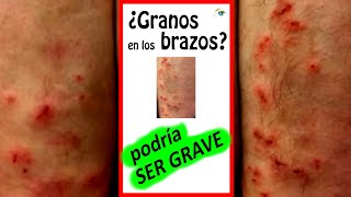 💥 GRANOS en los BRAZOS que PICAN 💥 Ampollas 💥 PICOR en la PIEL Dermatitis Herpetiforme FOTOS Shorts [upl. by Darra]