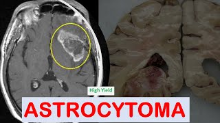 Brain Tumors Part1 Astrocytoma [upl. by Nylla]