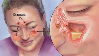 Conoce Como Puedes Eliminar Todo El Moco Y La Flema De Tu Garganta Y Pulmones [upl. by Altis]