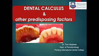 CALCULUS amp OTHER PREDISPOSING FACTORS [upl. by Ellirehs]