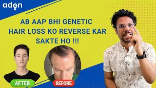 Kya Genetic Hair Loss Ko Reverse Kar Sakte hai [upl. by Marijn]