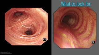 Mastering Bronchoscopy for Thoracic Surgery Chapter 5 [upl. by Aggarwal]