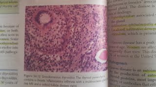 Subacute Lymphocytic and Granulomatous Thyroiditis  SPECIAL PATHOLOGY [upl. by Mikeb367]