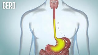 What is Gastroesophageal reflux disease GERD [upl. by Marjana900]