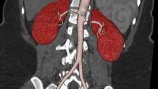 Bilateral renal arterial stenosis [upl. by Allemahs]