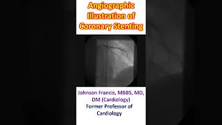 Angiographic Illustration of Coronary Stenting [upl. by Acirne]