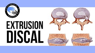 Extrusion discal ¿es realmente tan grave que es y porque se produce [upl. by Anoo816]