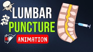 Lumbar Puncture  Spinal Tap and Epidural [upl. by Akila]