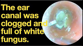 The ear canal was clogged and full of white fungusear wax removal  ear cleaning  ASMR relax [upl. by Ahsirtap]