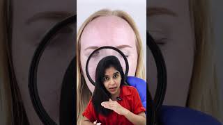 Pigmentary Demarcation Lines dermatologist dranvika transformation [upl. by Eymaj]