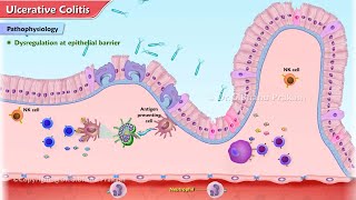 Ulcerative Colitis Animation  Etiology Clinical features Pathophysiology Diagnosis Treatment [upl. by Virgin]