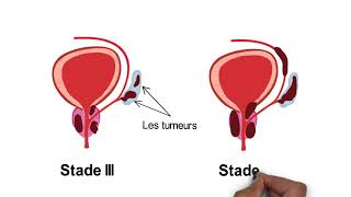 Comprendre le cancer de la prostate [upl. by Nnylylloh]