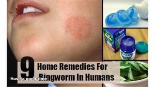 home remedies for ringworm [upl. by Glogau]