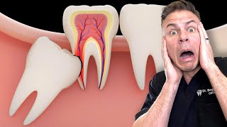 Is Removing Your Wisdom Teeth BAD For You [upl. by Cherri]