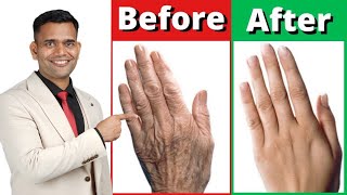 How To Make Your Hands Look 5 Years Younger  Wrinkle Free Smooth Hands  Dr Vivek Joshi [upl. by Gaal59]