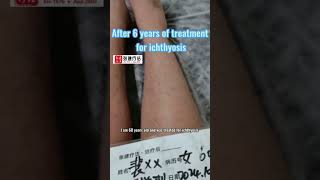 After 6 years of treatment for ichthyosis ichthyosis skincare dermatologist dryskinremedy [upl. by Norrek804]