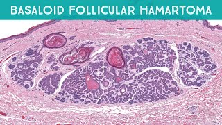 Basaloid Follicular Hamartoma linear multiple  mimic of basal cell carcinoma pathology dermpath [upl. by Kenley]