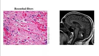 USMLE ACE Video 200 Classification and Pathophysiology of Common Adult and Pediatric Brain Tumors [upl. by Ma768]