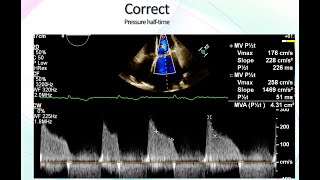 Mitral Stenosis Echocardiographic Assessment [upl. by Roede]