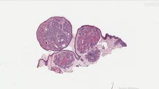 Skin Basaloid follicular hamartoma [upl. by Daisey]