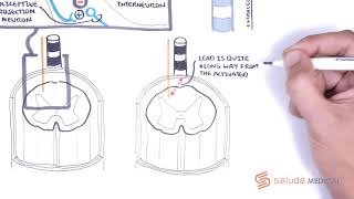 How ClosedLoop SCS Works Part 1 [upl. by Neyud]