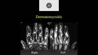 MRI of the Wrist Part 15  Wrist Inflammation [upl. by Annol]