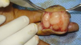 Lipoma Of Right Index Finger Removal [upl. by Colwin]