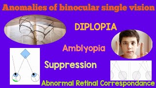 Binocular vision  Binocular single vision  Anomalies of binocular single vision  Cause behind BSV [upl. by La Verne]