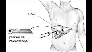 VOUS SAVEZ LA BIOPSIE HEPATIQUE [upl. by Ronyam]