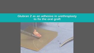 Glubran 2 as an adhesive in urethroplasty to fix the oral graft [upl. by Ttcos981]